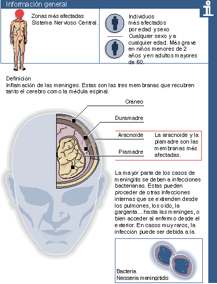 meningitis causas, tratamientos y como prevenir