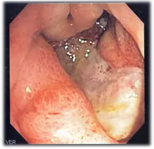 tengo gastritis así que te doy consejos para contrarrestarl