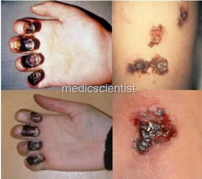 epidemias