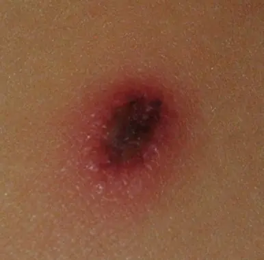 sida