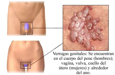 Verrugas vaginales, displasia y cáncer genital