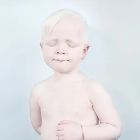 La frágil belleza de los albinos(arios)