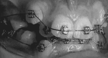 brackets