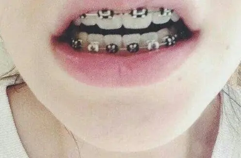 Cosas que le pasan a una persona que usan brackets
