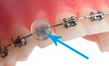 brackets