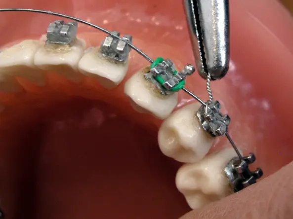 Cosas que le pasan a una persona que usan brackets