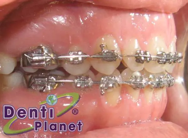 brackets