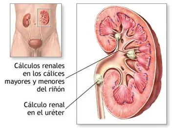 Cálculos renales: lo que usted debería saber