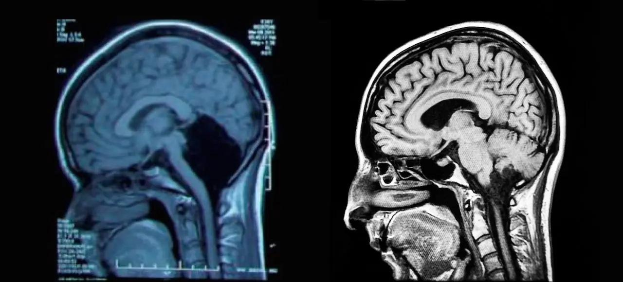 una mujer sin cerebelo desconcierta a los medicos