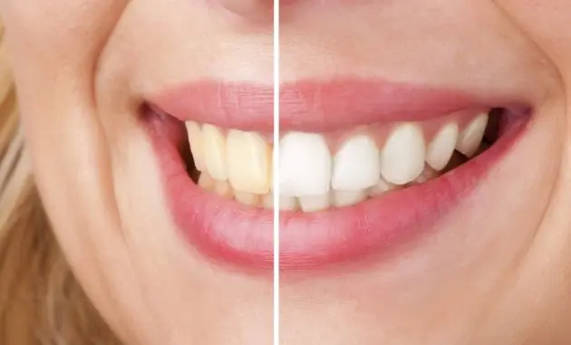 Tips para blanquear los dientes de forma natural