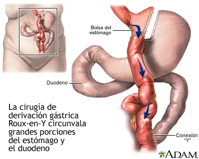 Bypass Gastrico / ¿Qué es y cómo funciona?