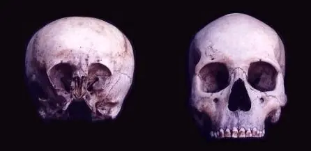 El cráneo de starchild: El niño de las estrellas