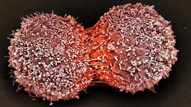Un adolescente inventa el mejor 'detector' de cáncer de pá
