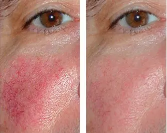 rosacea