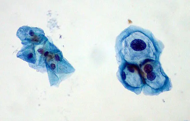 cancer uterino