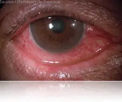 Super post sobre Conjuntivitis