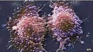 Exitosa técnica de ultrasonido para cáncer de próstata