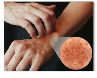 Acné