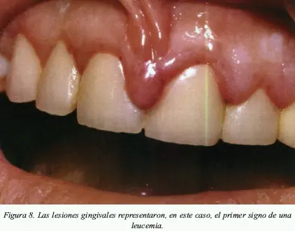 Periodontitis