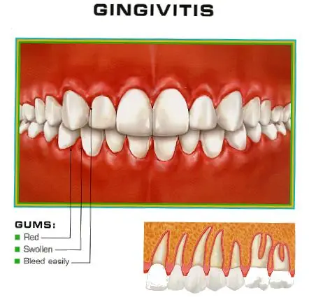 Gingivitis