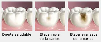 La caries