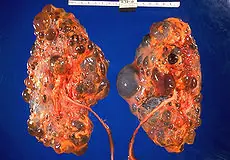 Enfermedad renal poliquística (ERP)