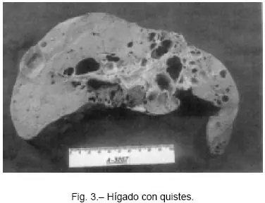 Enfermedad renal poliquística (ERP)