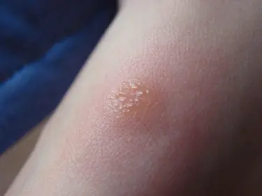 Ataques ponzoñosos en niños