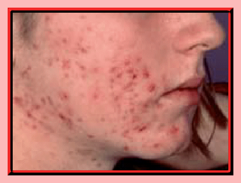 La cura para el acne (solo valido para Mexico