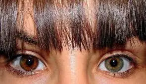 heterocromia