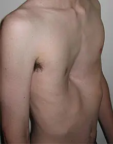 Deformidad Fisica (Esta es mi verdad)