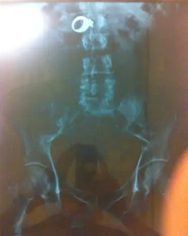 heridas