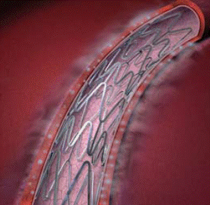 Nitinol: el metal inteligente