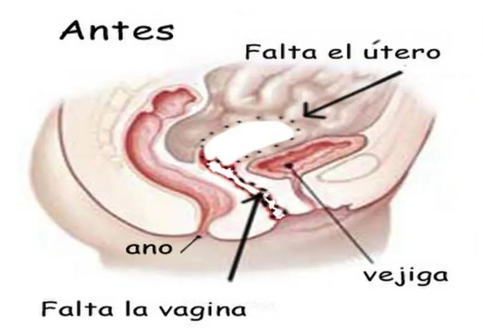 La joven con la vagina implantada