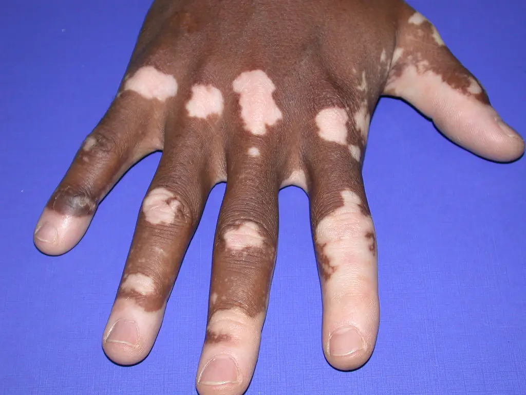 el Vitiligo tiene cura