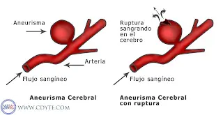aneurisma abdominal