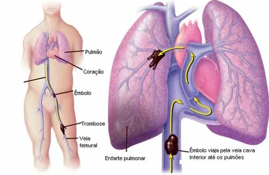 EPOC