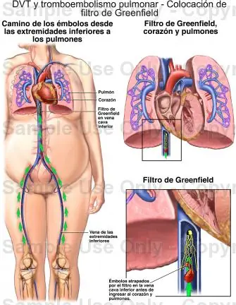 enfisema