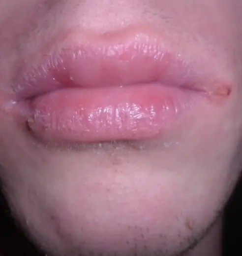 Experiencia con Isotretinoina. Acné.