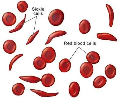 Anemia