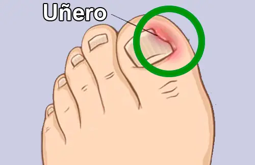 ¿Cómo curamos naturalmente los uñeros?