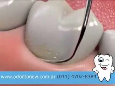 como blanquear los dientes en un dia en casa