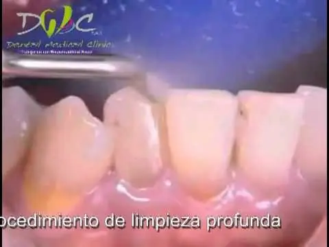 Blanquear dientes en casa