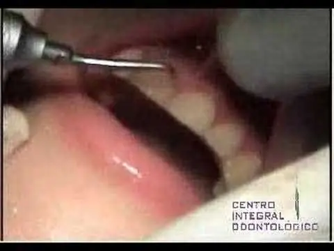 productos para blanquear los dientes en casa