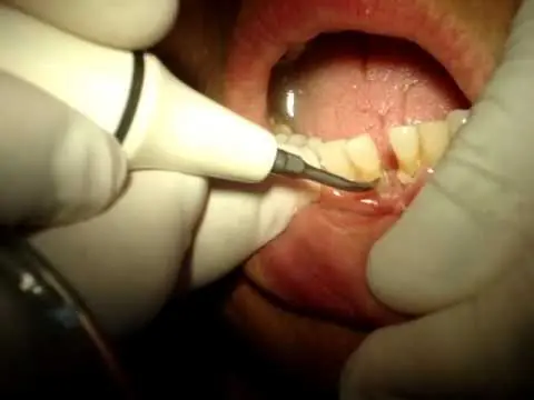 blanquear dientes en casa rapido