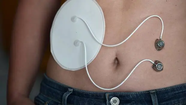 Implantan primer páncreas artificial en niño de 4 años