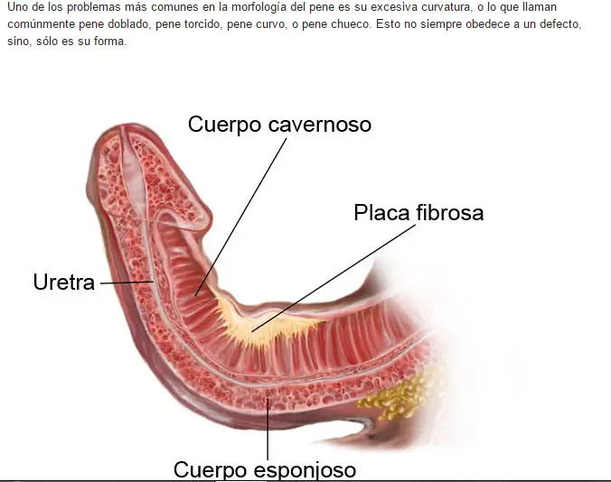 Tenes el pene torcido? Pasa!