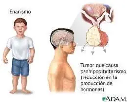 hipopituitarismo