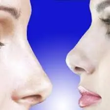 Tabique nasal desviado...?