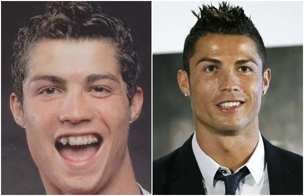 Cristiano Ronaldo con "carillas dentales"